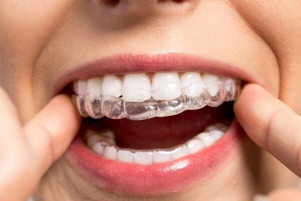 How Does Invisalign Work