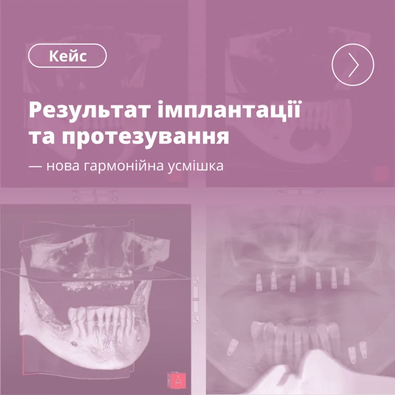Результат комплексної реабілітації усмішки