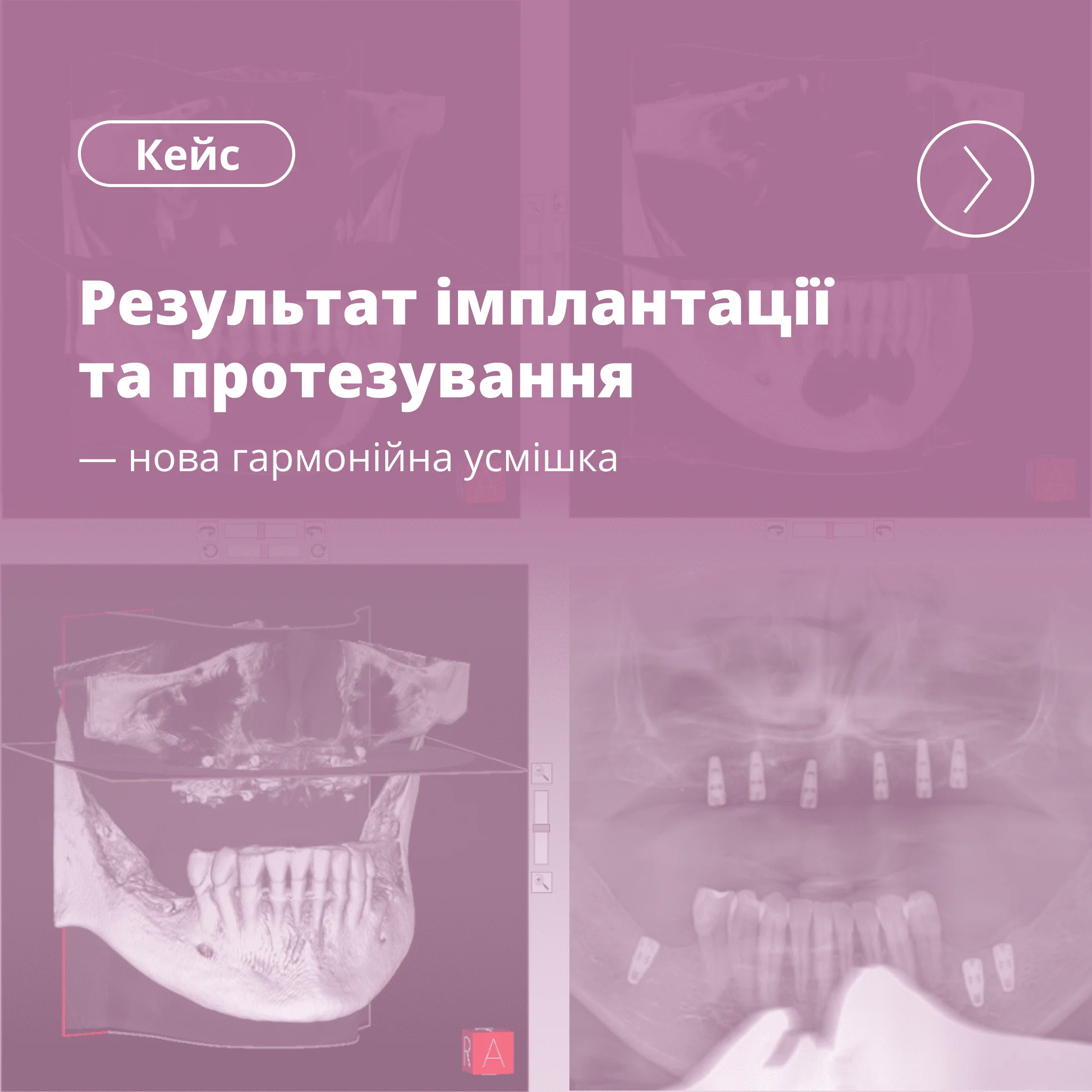 Результат комплексної реабілітації усмішки